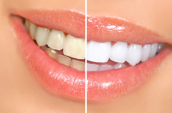 Teeth Whitening Racine