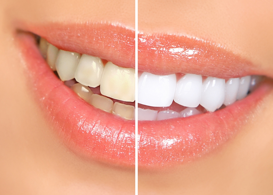 Teeth Whitening Racine