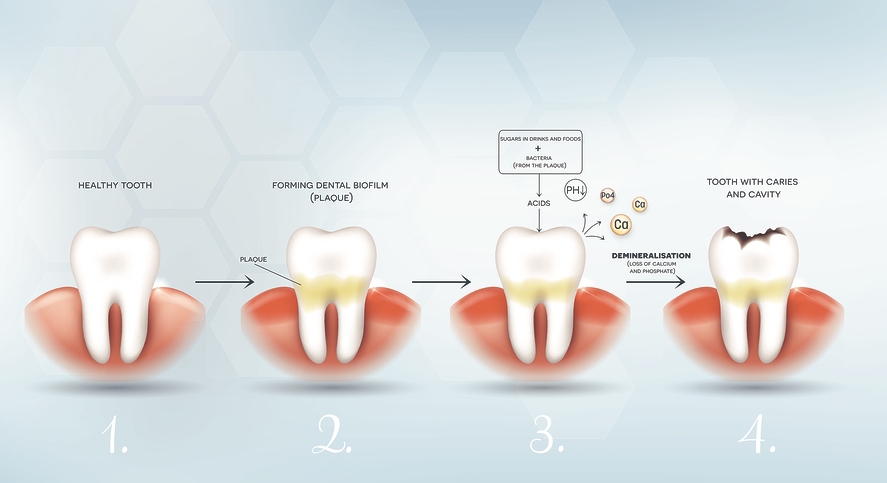 Plaque vs. tartar: Differences, formation, and more