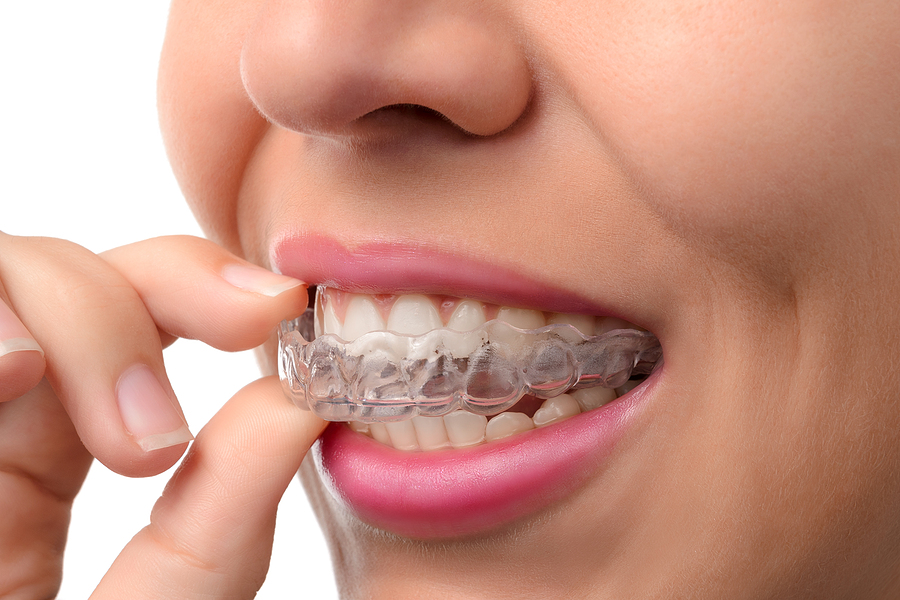 The benefits of space maintainers and clear braces in preventing dental  issues